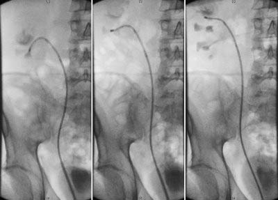 ureteroscope-souple2